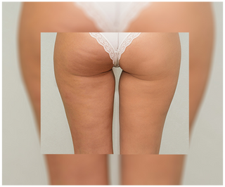 Cellulite-Tabletten und Hautbildverbesserung mit natürlichen Extrakten Cellinea 60 Kapseln