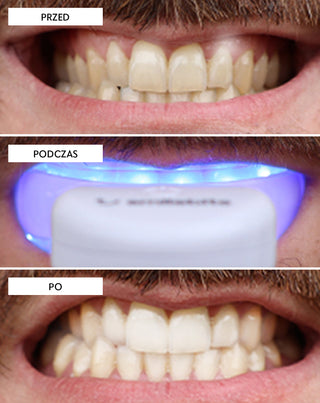 Zahnaufhellungsset mit LED-Lampe und Light &amp;amp; Bright Smilebite-Aufhellungsgel