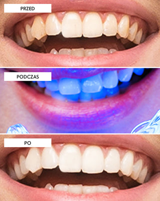 Zahnaufhellungsset mit LED-Lampe und Light &amp;amp; Bright Smilebite-Aufhellungsgel